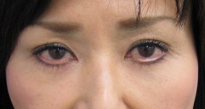 目の下のたるみ、目のくまでお悩みの方、切らずに完璧に解決します。TCB-R法　手術直後　症例写真